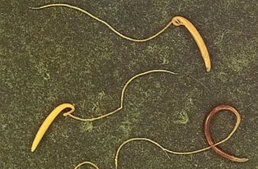 vretenica z ľudského tela