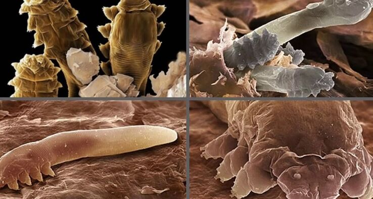 typy ľudských kožných parazitov